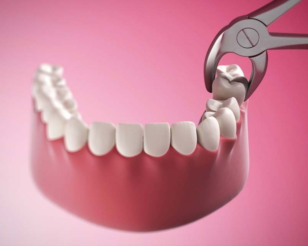 Quy trình nhổ răng khôn gồm các bước nào